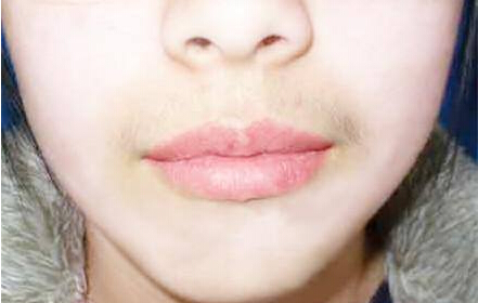 微量元素檢測儀女神節福利女性長胡子內分泌紊亂 微量元素檢測儀女神節福利女性長胡子內分泌紊亂